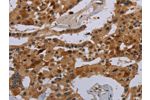 The image on the left is immunohistochemistry of paraffin-embedded Human prostate cancer tissue using CSB-PA203427(COX18 Antibody) at dilution 1/20, on the right is treated with synthetic peptide. (Original magnification: 