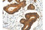 The image on the left is immunohistochemistry of paraffin-embedded Human colorectal cancer tissue using CSB-PA203676(AQP3 Antibody) at dilution 1/35, on the right is treated with synthetic peptide. (Original magnification: 