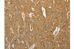 The image on the left is immunohistochemistry of paraffin-embedded Human ovarian cancer tissue using CSB-PA204064(AKR1B1 Antibody) at dilution 1/40, on the right is treated with synthetic peptide. (Original magnification: 