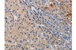 The image on the left is immunohistochemistry of paraffin-embedded Human liver cancer tissue using CSB-PA204342(CD207 Antibody) at dilution 1/40, on the right is treated with fusion protein. (Original magnification: 