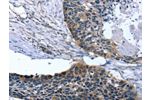 The image on the left is immunohistochemistry of paraffin-embedded Human esophagus cancer tissue using CSB-PA204496(ARMC10 Antibody) at dilution 1/30, on the right is treated with fusion protein. (Original magnification: 