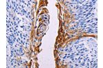 The image on the left is immunohistochemistry of paraffin-embedded Human esophagus cancer tissue using CSB-PA204706(FGF7 Antibody) at dilution 1/15, on the right is treated with synthetic peptide. (Original magnification: 
