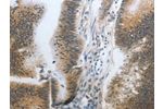 The image on the left is immunohistochemistry of paraffin-embedded Human colon cancer tissue using CSB-PA205008(CST3 Antibody) at dilution 1/20, on the right is treated with synthetic peptide. (Original magnification: 