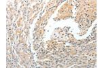 The image on the left is immunohistochemistry of paraffin-embedded Human cervical cancer tissue using CSB-PA205301(CD93 Antibody) at dilution 1/50, on the right is treated with synthetic peptide. (Original magnification: 