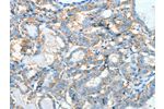 The image on the left is immunohistochemistry of paraffin-embedded Human thyroid cancer tissue using CSB-PA205525(AGBL3 Antibody) at dilution 1/45, on the right is treated with fusion protein. (Original magnification: 