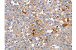 The image on the left is immunohistochemistry of paraffin-embedded Human breast cancer tissue using CSB-PA205738(GJB6 Antibody) at dilution 1/15, on the right is treated with synthetic peptide. (Original magnification: 