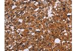 The image on the left is immunohistochemistry of paraffin-embedded Human thyroid cancer tissue using CSB-PA205879(EGR4 Antibody) at dilution 1/20, on the right is treated with synthetic peptide. (Original magnification: 
