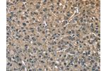The image on the left is immunohistochemistry of paraffin-embedded Human liver cancer tissue using CSB-PA205920(ENO1 Antibody) at dilution 1/40, on the right is treated with fusion protein. (Original magnification: 
