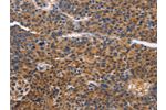 The image on the left is immunohistochemistry of paraffin-embedded Human liver cancer tissue using CSB-PA206692(ACVR2B Antibody) at dilution 1/50, on the right is treated with fusion protein. (Original magnification: 