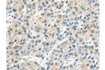 The image on the left is immunohistochemistry of paraffin-embedded Human liver cancer tissue using CSB-PA207910(AHI1 Antibody) at dilution 1/25, on the right is treated with synthetic peptide. (Original magnification: 