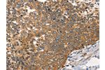 The image on the left is immunohistochemistry of paraffin-embedded Human cervical cancer tissue using CSB-PA208126(AGO1 Antibody) at dilution 1/40, on the right is treated with synthetic peptide. (Original magnification: 