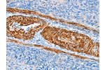 The image on the left is immunohistochemistry of paraffin-embedded Human cervical cancer tissue using CSB-PA208319(AARS Antibody) at dilution 1/60, on the right is treated with synthetic peptide. (Original magnification: 