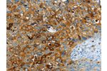 The image on the left is immunohistochemistry of paraffin-embedded Human cervical cancer tissue using CSB-PA208943(ASAH1 Antibody) at dilution 1/40, on the right is treated with fusion protein. (Original magnification: 