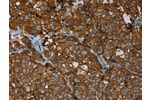 The image on the left is immunohistochemistry of paraffin-embedded Human breast cancer tissue using CSB-PA209003(ERBB4 Antibody) at dilution 1/40, on the right is treated with fusion protein. (Original magnification: 