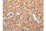 The image on the left is immunohistochemistry of paraffin-embedded Human liver cancer tissue using CSB-PA209578(BSN Antibody) at dilution 1/20, on the right is treated with synthetic peptide. (Original magnification: 