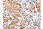The image on the left is immunohistochemistry of paraffin-embedded Human prostate cancer tissue using CSB-PA209620(CENPC Antibody) at dilution 1/70, on the right is treated with fusion protein. (Original magnification: 
