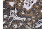 The image on the left is immunohistochemistry of paraffin-embedded Human colon cancer tissue using CSB-PA209664(GK Antibody) at dilution 1/60, on the right is treated with fusion protein. (Original magnification: 