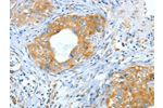 The image on the left is immunohistochemistry of paraffin-embedded Human cervical cancer tissue using CSB-PA210142(ASNS Antibody) at dilution 1/60, on the right is treated with fusion protein. (Original magnification: 