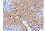 The image on the left is immunohistochemistry of paraffin-embedded Human cervical cancer tissue using CSB-PA210249(ABO Antibody) at dilution 1/50, on the right is treated with synthetic peptide. (Original magnification: 