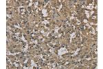 The image on the left is immunohistochemistry of paraffin-embedded Human thyroid cancer tissue using CSB-PA210409(DCTN3 Antibody) at dilution 1/70, on the right is treated with fusion protein. (Original magnification: 