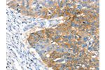 The image on the left is immunohistochemistry of paraffin-embedded Human lung cancer tissue using CSB-PA210438(CRADD Antibody) at dilution 1/25, on the right is treated with fusion protein. (Original magnification: 