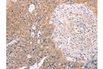 The image on the left is immunohistochemistry of paraffin-embedded Human cervical cancer tissue using CSB-PA210688(DCT Antibody) at dilution 1/25, on the right is treated with fusion protein. (Original magnification: 
