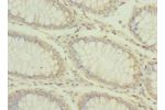 Immunohistochemistry of paraffin-embedded human colon cancer using CSB-PA2107ESR1HU at dilution 1:100