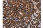 The image on the left is immunohistochemistry of paraffin-embedded Human thyroid cancer tissue using CSB-PA211015(DISC1 Antibody) at dilution 1/30, on the right is treated with synthetic peptide. (Original magnification: 