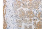 The image on the left is immunohistochemistry of paraffin-embedded Human liver cancer tissue using CSB-PA211297(ADRB2 Antibody) at dilution 1/20, on the right is treated with synthetic peptide. (Original magnification: 
