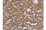 The image on the left is immunohistochemistry of paraffin-embedded Human thyroid cancer tissue using CSB-PA211579(AAAS Antibody) at dilution 1/20, on the right is treated with fusion protein. (Original magnification: 