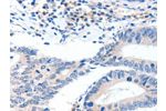 The image on the left is immunohistochemistry of paraffin-embedded Human colon cancer tissue using CSB-PA211635(GCK Antibody) at dilution 1/40, on the right is treated with synthetic peptide. (Original magnification: 