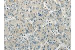 The image on the left is immunohistochemistry of paraffin-embedded Human liver cancer tissue using CSB-PA212701(AICDA Antibody) at dilution 1/35, on the right is treated with synthetic peptide. (Original magnification: 