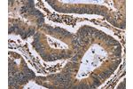 The image is immunohistochemistry of paraffin-embedded Human colon cancer tissue using CSB-PA212749(GADD45B Antibody) at dilution 1/30. (Original magnification: 