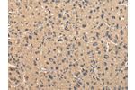 The image on the left is immunohistochemistry of paraffin-embedded Human liver cancer tissue using CSB-PA212919(BMP4 Antibody) at dilution 1/40, on the right is treated with fusion protein. (Original magnification: 