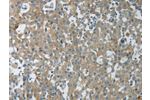 The image on the left is immunohistochemistry of paraffin-embedded Human breast cancer tissue using CSB-PA212989(CXCR3 Antibody) at dilution 1/15, on the right is treated with fusion protein. (Original magnification: 