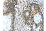 The image on the left is immunohistochemistry of paraffin-embedded Human colon cancer tissue using CSB-PA213653(BAD Antibody) at dilution 1/60, on the right is treated with fusion protein. (Original magnification: 
