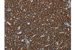 The image on the left is immunohistochemistry of paraffin-embedded Human ovarian cancer tissue using CSB-PA215070(GCKR Antibody) at dilution 1/40, on the right is treated with fusion protein. (Original magnification: 