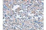 The image on the left is immunohistochemistry of paraffin-embedded Human thyroid cancer tissue using CSB-PA215086(FGF9 Antibody) at dilution 1/25, on the right is treated with fusion protein. (Original magnification: 