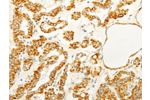 The image on the left is immunohistochemistry of paraffin-embedded Human thyroid cancer tissue using CSB-PA215116(FOXR2 Antibody) at dilution 1/25, on the right is treated with fusion protein. (Original magnification: 