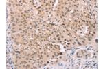 The image on the left is immunohistochemistry of paraffin-embedded Human lung cancer tissue using CSB-PA215248(ADAM11 Antibody) at dilution 1/25, on the right is treated with synthetic peptide. (Original magnification: 
