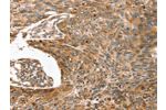 The image on the left is immunohistochemistry of paraffin-embedded Human esophagus cancer tissue using CSB-PA215261(ERVW-1 Antibody) at dilution 1/45, on the right is treated with synthetic peptide. (Original magnification: 
