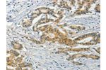 The image on the left is immunohistochemistry of paraffin-embedded Human colon cancer tissue using CSB-PA215341(ASB8 Antibody) at dilution 1/50, on the right is treated with fusion protein. (Original magnification: 