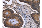 The image is immunohistochemistry of paraffin-embedded Human colon cancer tissue using CSB-PA215571(FRK Antibody) at dilution 1/40. (Original magnification: 