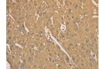 The image on the left is immunohistochemistry of paraffin-embedded Human liver cancer tissue using CSB-PA215588(CD40 Antibody) at dilution 1/70, on the right is treated with synthetic peptide. (Original magnification: 