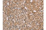 The image on the left is immunohistochemistry of paraffin-embedded Human prostate cancer tissue using CSB-PA215866(CHRNA4 Antibody) at dilution 1/20, on the right is treated with fusion protein. (Original magnification: 