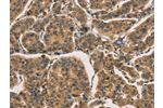 The image on the left is immunohistochemistry of paraffin-embedded Human breast cancer tissue using CSB-PA216273(CTNNBIP1 Antibody) at dilution 1/30, on the right is treated with fusion protein. (Original magnification: 