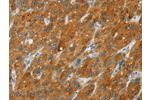 The image on the left is immunohistochemistry of paraffin-embedded Human liver cancer tissue using CSB-PA216877(CYP2E1 Antibody) at dilution 1/30, on the right is treated with fusion protein. (Original magnification: 