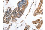 The image on the left is immunohistochemistry of paraffin-embedded Human colon cancer tissue using CSB-PA217516(AKR1D1 Antibody) at dilution 1/35, on the right is treated with fusion protein. (Original magnification: 