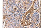 The image on the left is immunohistochemistry of paraffin-embedded Human esophagus cancer tissue using CSB-PA217773(ANXA6 Antibody) at dilution 1/17, on the right is treated with fusion protein. (Original magnification: 