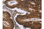 The image on the left is immunohistochemistry of paraffin-embedded Human colon cancer tissue using CSB-PA217817(FGFR1OP Antibody) at dilution 1/50, on the right is treated with fusion protein. (Original magnification: 